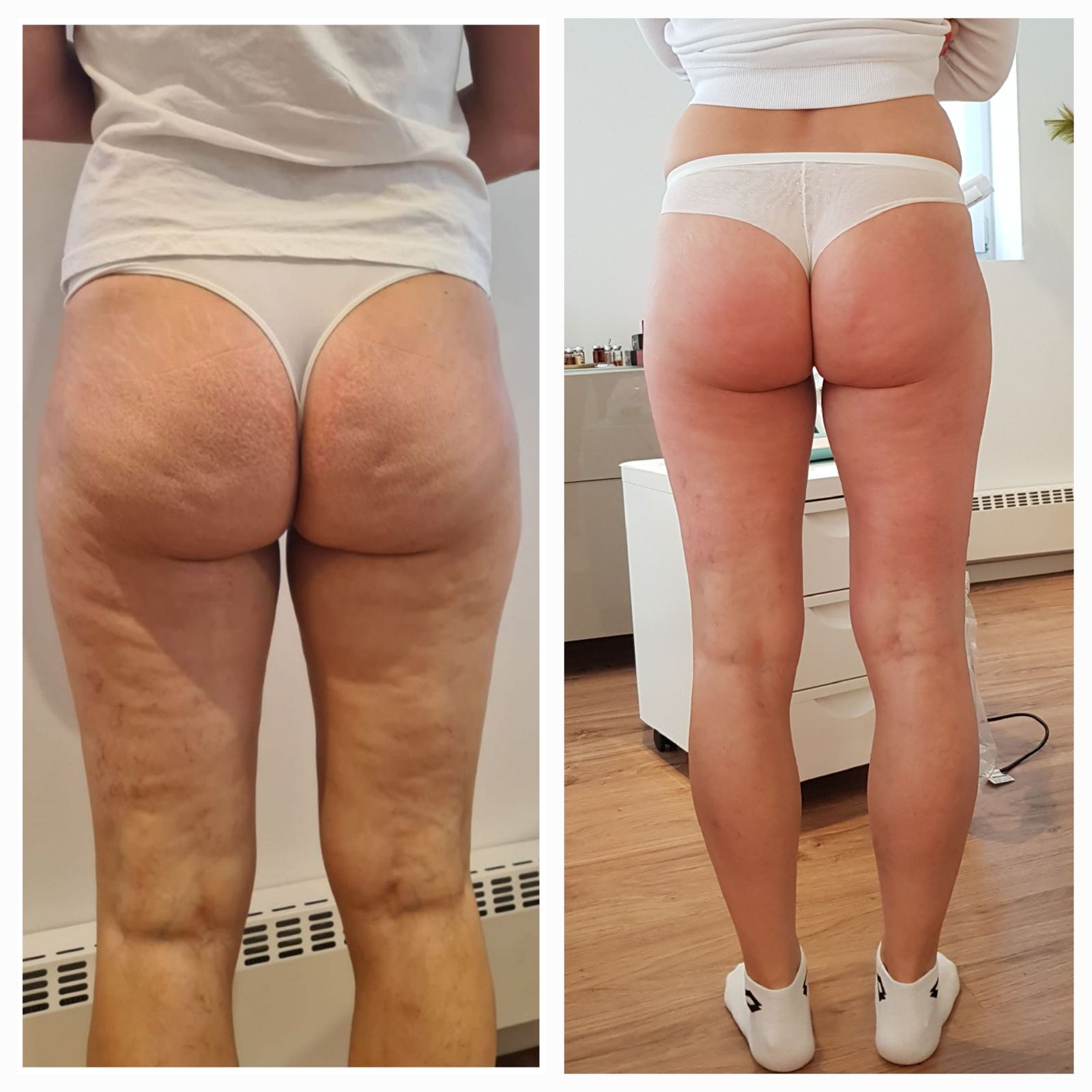 Cellulite an Oberschenkeln vorher und nachher